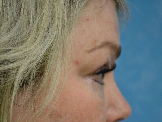 Eye Lift (Blepharoplasty): Case 1770- Sylvania, OH - After