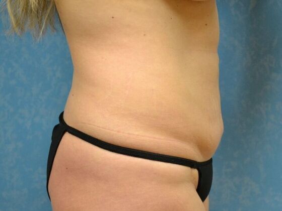 Liposuction: Case 1717- Sylvania, OH - Before