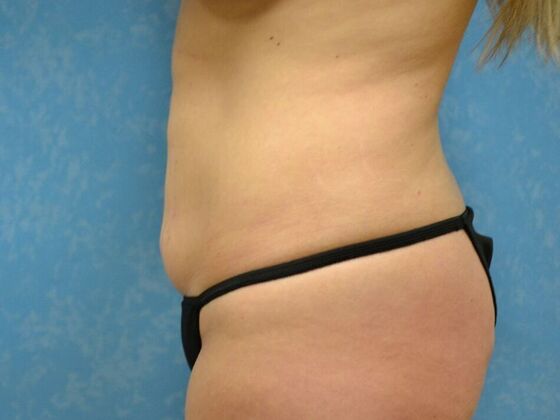 Liposuction: Case 1717- Sylvania, OH - Before