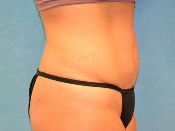 Liposuction: Case 1717- Sylvania, OH - After