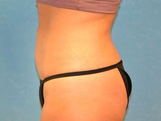 Liposuction: Case 1717- Sylvania, OH - After