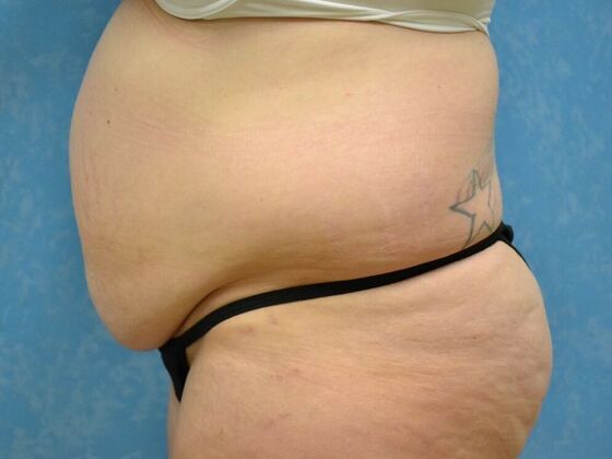 Tummy Tuck: Case 1796- Tiffin, OH - Before