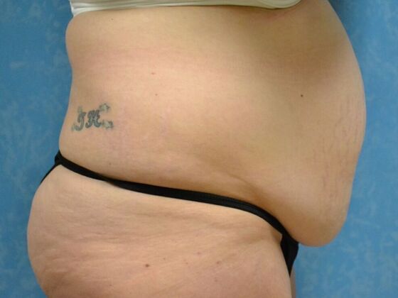 Tummy Tuck: Case 1796- Tiffin, OH - Before