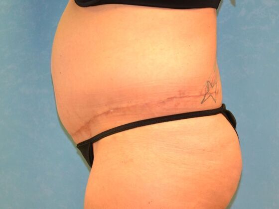 Tummy Tuck: Case 1796- Tiffin, OH - After