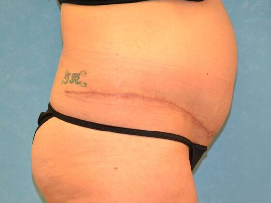 Tummy Tuck: Case 1796- Tiffin, OH - After
