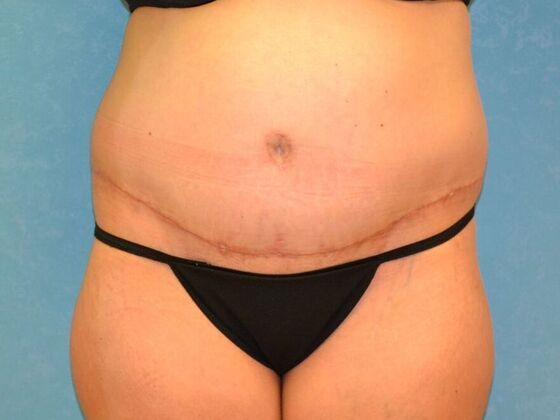 Tummy Tuck: Case 1796- Tiffin, OH - After