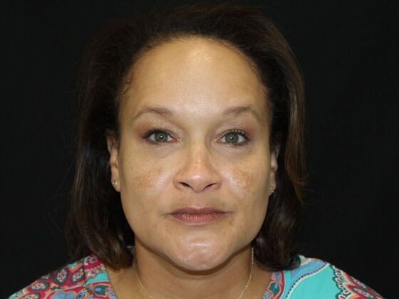 Skin Treatments Case 6 - Before