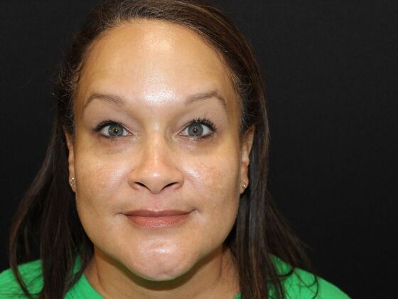 Skin Treatments Case 6 - After