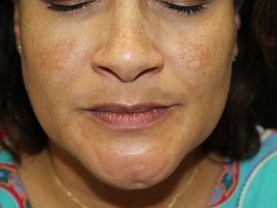 Skin Treatments: Case 6 - Before