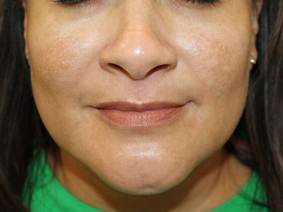 Skin Treatments: Case 6 - After