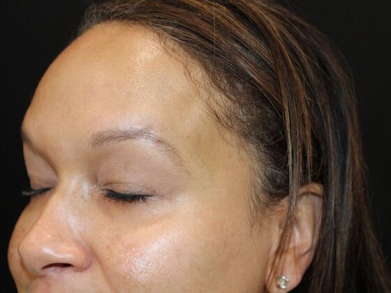 Skin Treatments: Case 6 - After