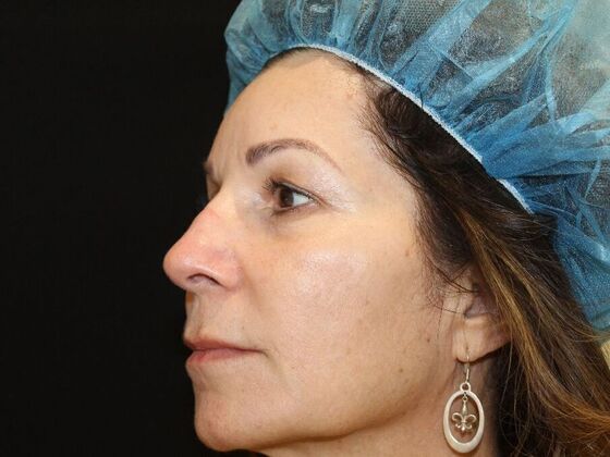 Skin Treatments: Case 7 - After