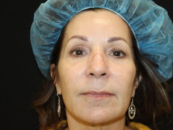 Skin Treatments Case 7 - After