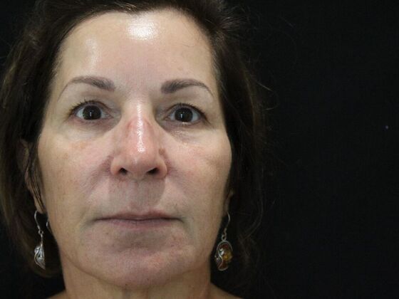 Skin Treatments Case 7 - Before