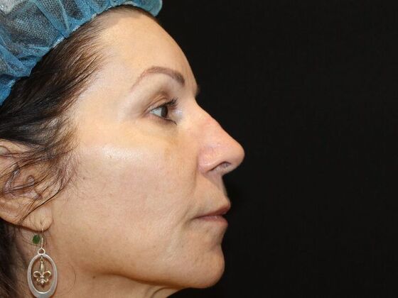 Skin Treatments: Case 7 - After