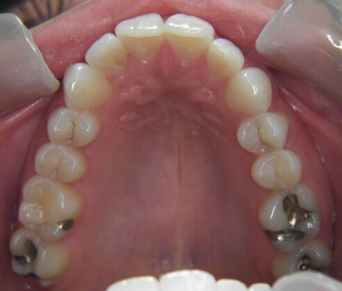 Invisalign: Case 1 - Before