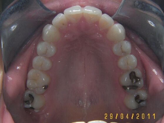 Invisalign: Case 1 - After