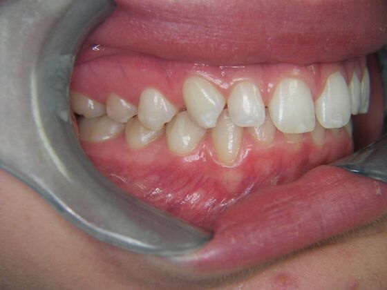 Invisalign: Case 2 - Before