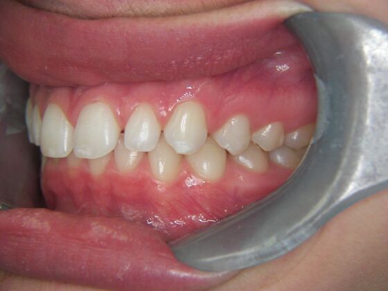 Invisalign: Case 2 - Before