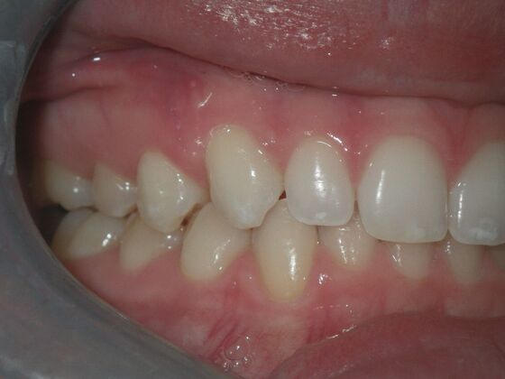Invisalign: Case 2 - After