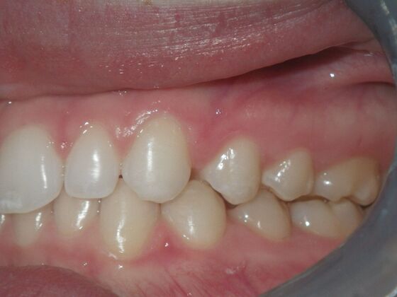 Invisalign: Case 2 - After