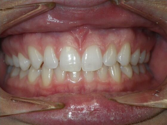 Invisalign: Case 2 - Before