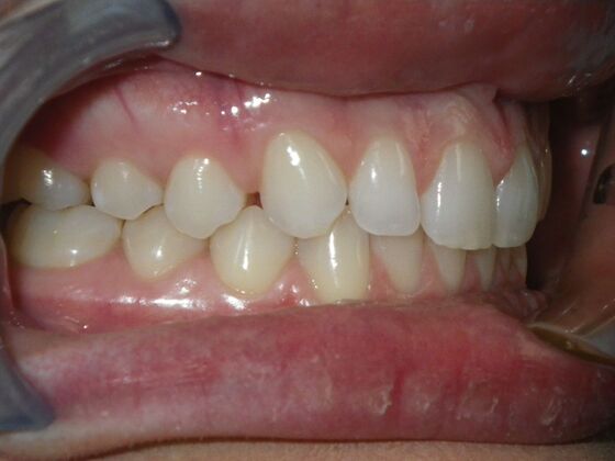 Invisalign: Case 2 - Before
