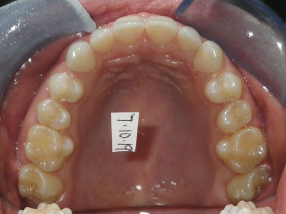 Invisalign: Case 2 - Before