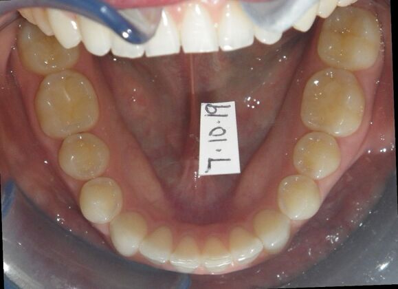 Invisalign: Case 2 - Before