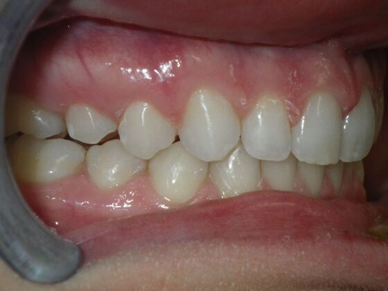Invisalign: Case 2 - After