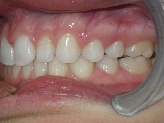 Invisalign: Case 2 - After