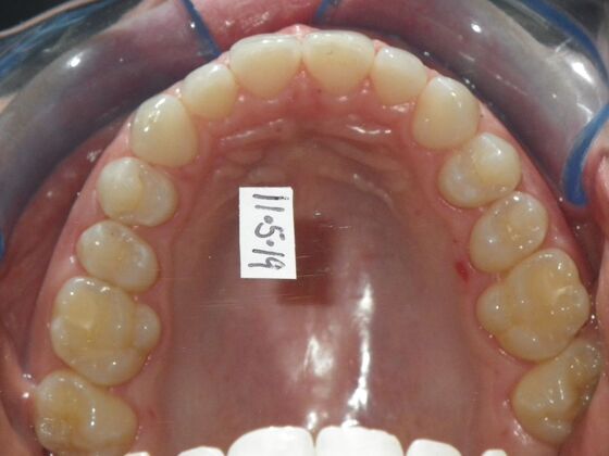 Invisalign: Case 2 - After