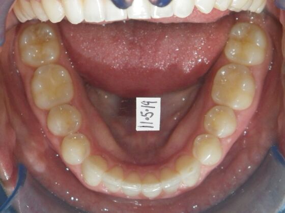 Invisalign: Case 2 - After
