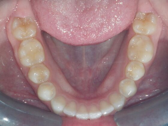 Invisalign: Case 2 - After