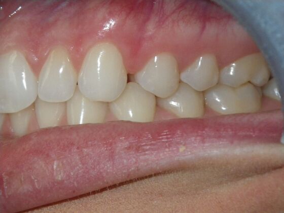 Invisalign: Case 2 - Before