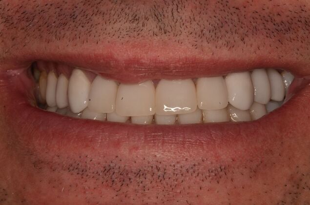 Porcelain Veneers: Case 34 - After upper and lower Porcelain veneers
