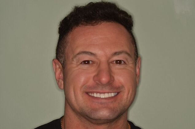 Porcelain Veneers: Case 34 - After upper and lower Porcelain veneers