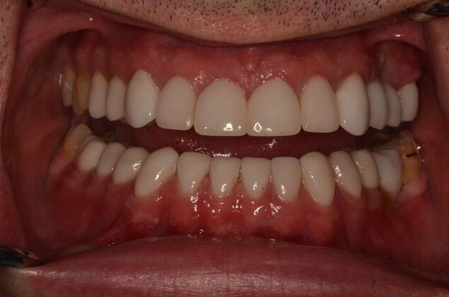 Porcelain Veneers: Case 34 - After upper and lower Porcelain veneers