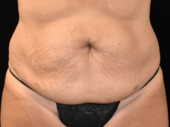 Abdominoplasty: Case 2 - Before