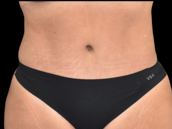 Abdominoplasty: Case 2 - After