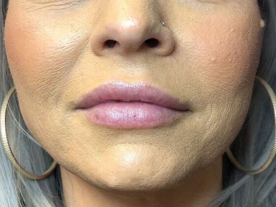 Cosmetic Injectables & Fillers*: Case 45 Lip Filler - Before
