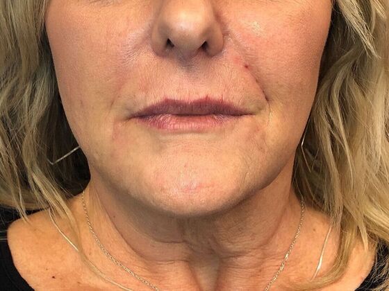 Cosmetic Injectables & Fillers*: Case 48 Lower Face Filler - After