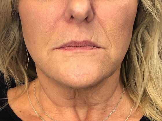 Cosmetic Injectables & Fillers*: Case 48 Lower Face Filler - Before