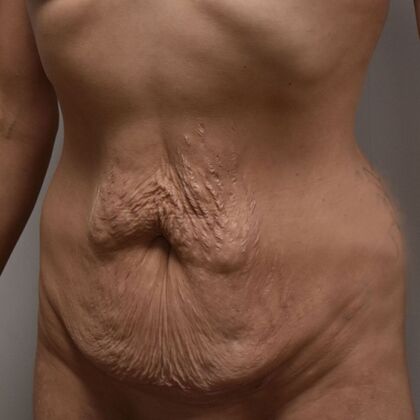 Tummy Tuck (Abdominoplasty): Case 424 - Before