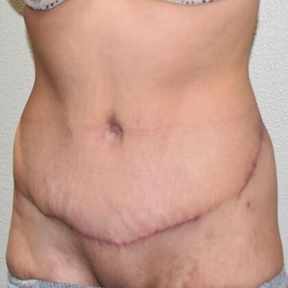 Tummy Tuck (Abdominoplasty): Case 424 - After