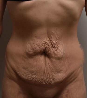Tummy Tuck (Abdominoplasty): Case 424 - Before