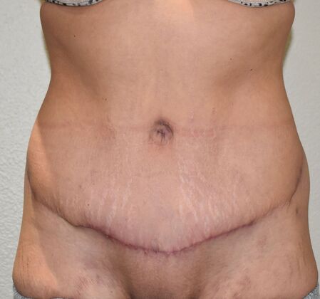 Tummy Tuck (Abdominoplasty): Case 424 - After