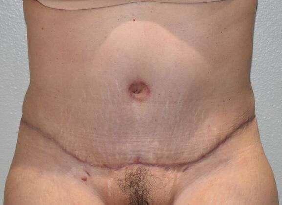 Tummy Tuck (Abdominoplasty): Case 425 - After