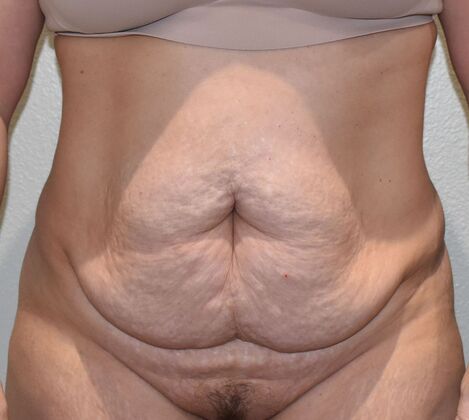 Tummy Tuck (Abdominoplasty): Case 425 - Before