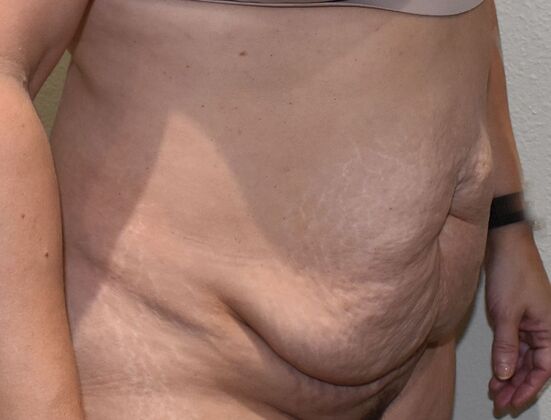 Tummy Tuck (Abdominoplasty): Case 425 - Before